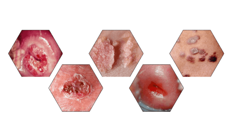 Miks on papilloomid ohtlikud