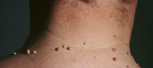 kuidas papilloomidest lahti saada