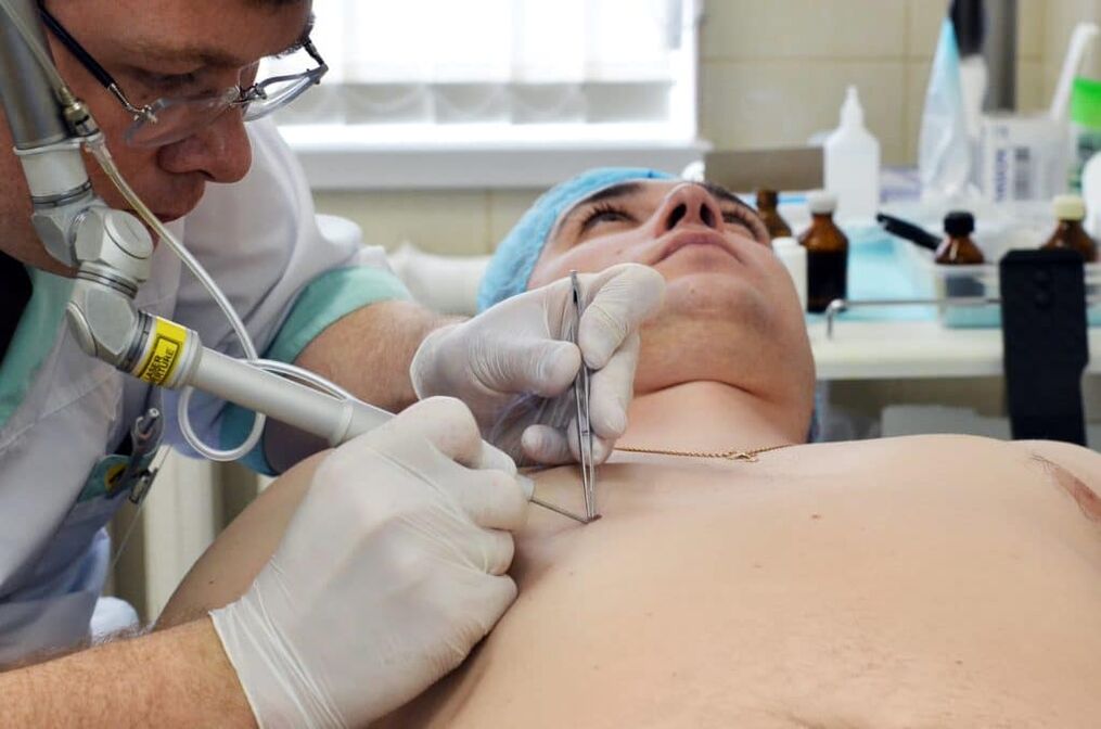 kuidas vabaneda tüükadest kehal