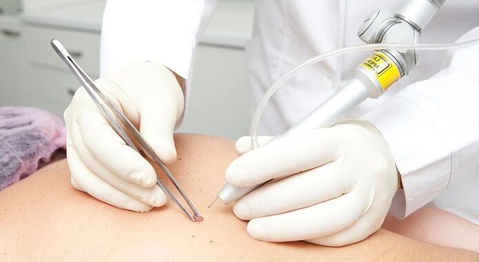 papilloomi eemaldamine laseriga papilloomiviiruse jaoks